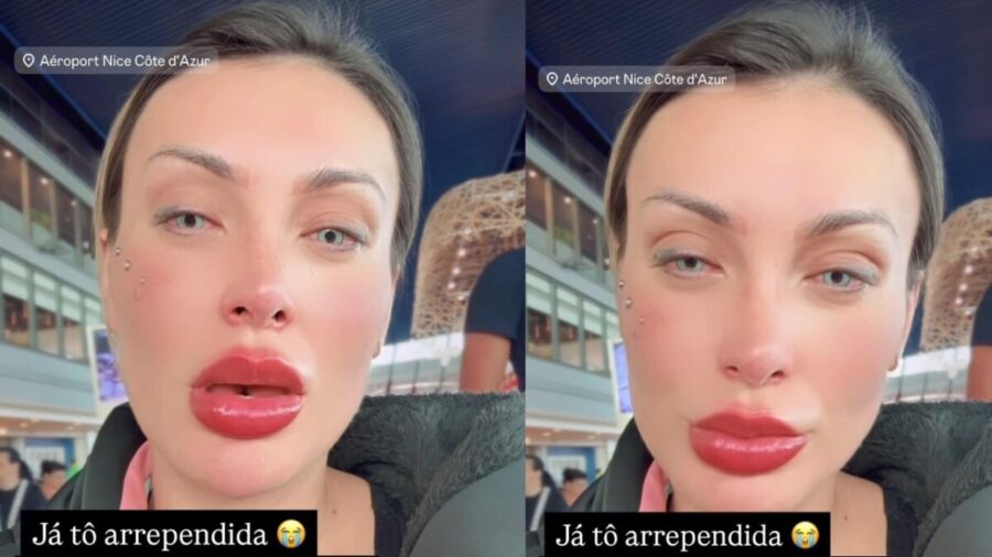 Andressa-Urach-sofre-complicação-após-cirurgia-ocular (1)